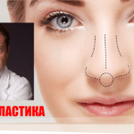 Левицкий ринопластика