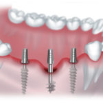 bezboleznennaya-impl