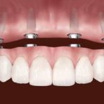 Протезування при повній відсутності зубів: комфорт і впевненість у кожній посмішці protezirovanie-pri-polnom-otsutstvii-zubov